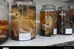 Vietnamese-Fetuses-2